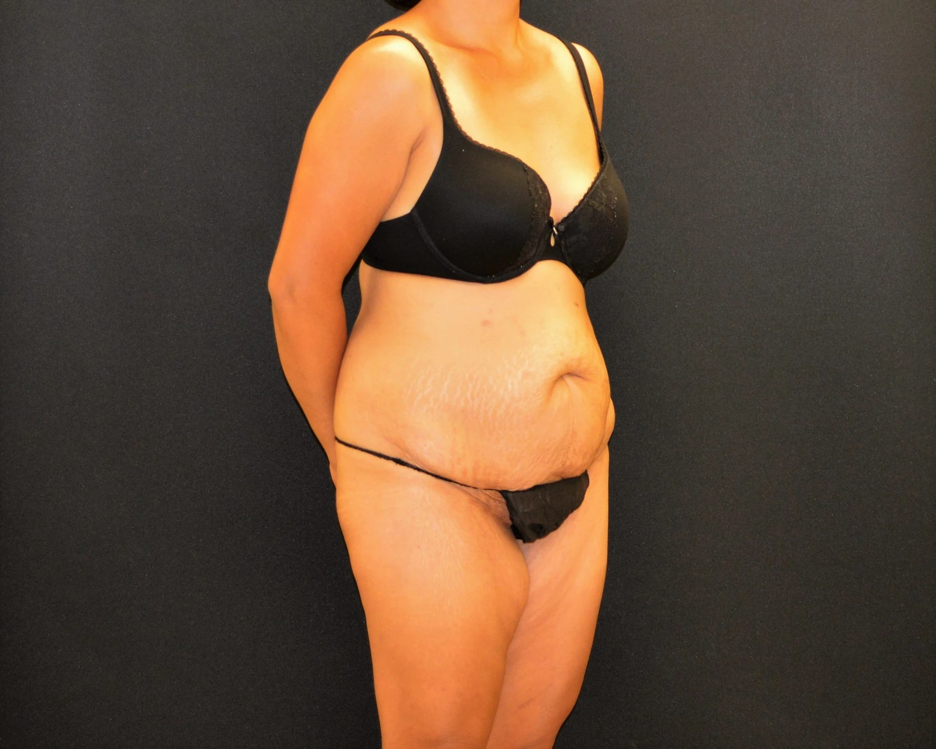 C.L.A.S.S. Tummy Tuck™ - Case 443 - Before