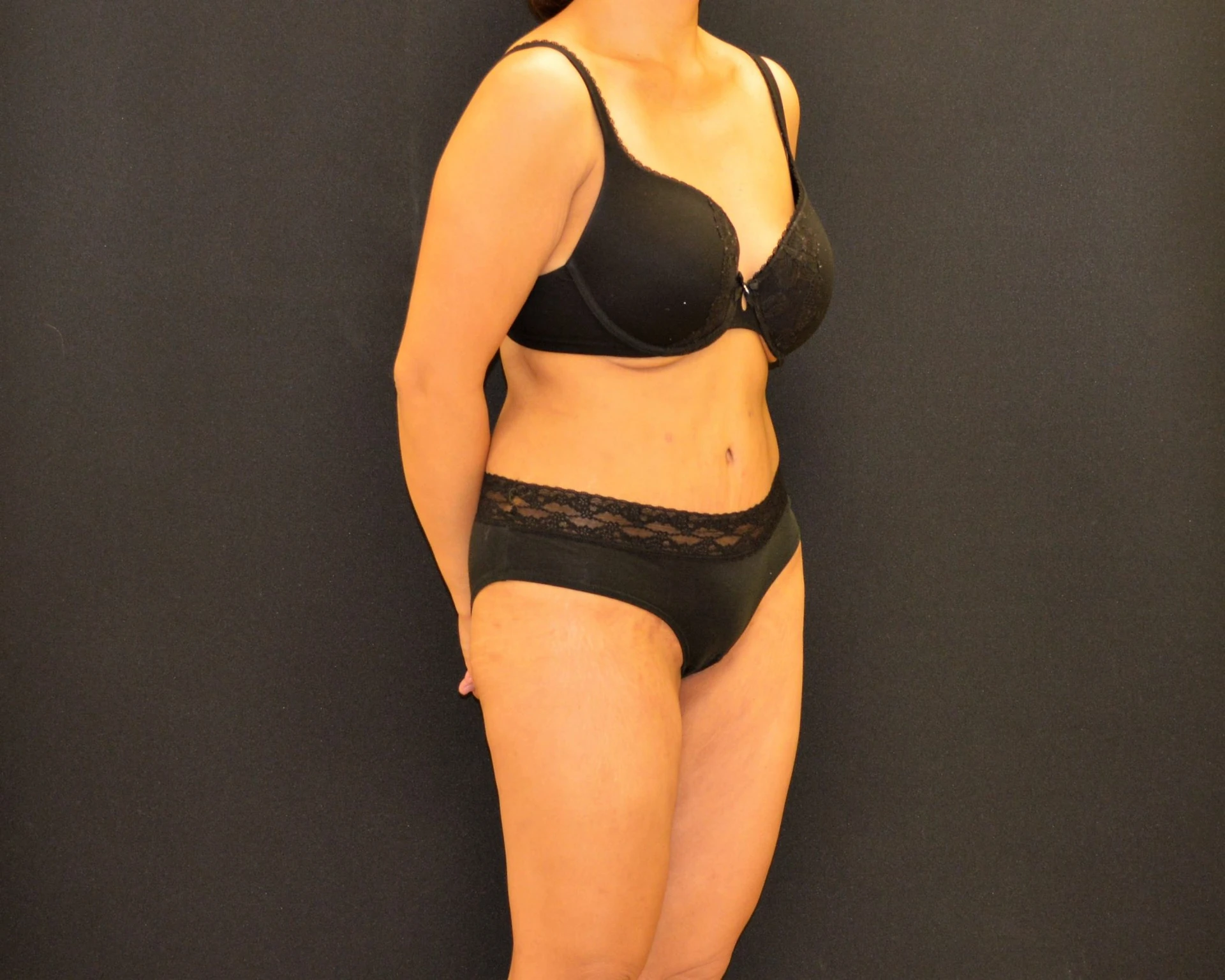 C.L.A.S.S. Tummy Tuck™ - Case 443 - After