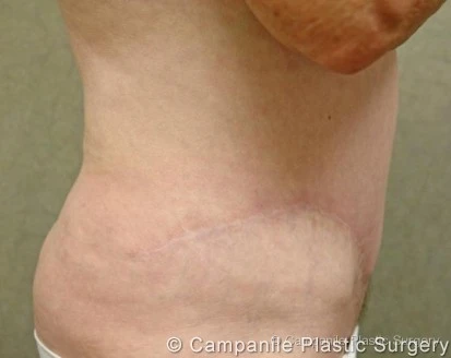 C.L.A.S.S. Tummy Tuck™ - Case 42 - After