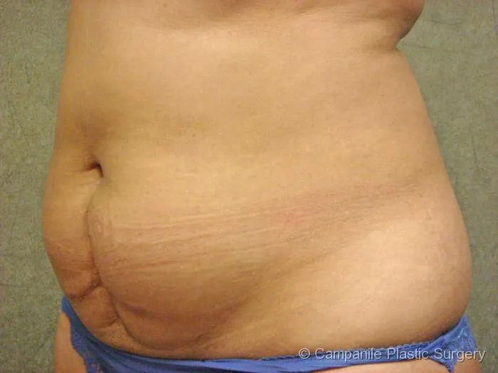 C.L.A.S.S. Tummy Tuck™ Patient Photo - Case 32 - before view-1