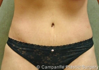 C.L.A.S.S. Tummy Tuck™ - Case 24 - After