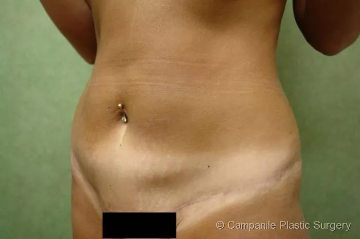 Tummy Tuck Revision Patient Photo - Case 50 - before view-1