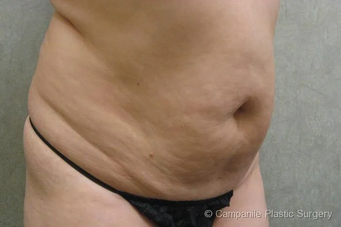 C.L.A.S.S. Tummy Tuck™ Patient Photo - Case 21 - before view-