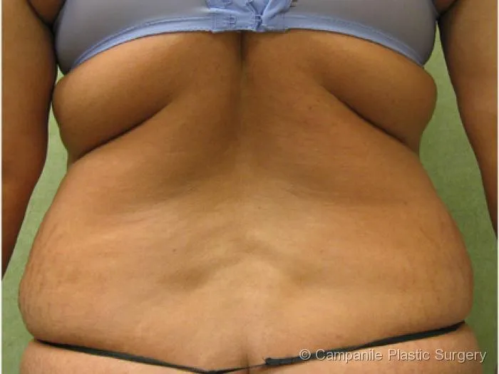 Liposuction - Case 75 - Before
