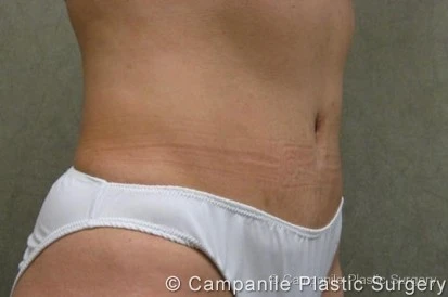 C.L.A.S.S. Tummy Tuck™ Patient Photo - Case 30 - after view-1