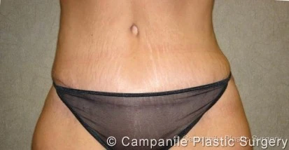 C.L.A.S.S. Tummy Tuck™ - Case 28 - After