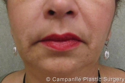 Medical Spa Procedures - Case 12 - After