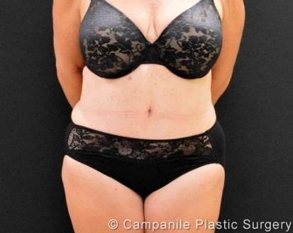 C.L.A.S.S. Tummy Tuck™ - Case 310 - After