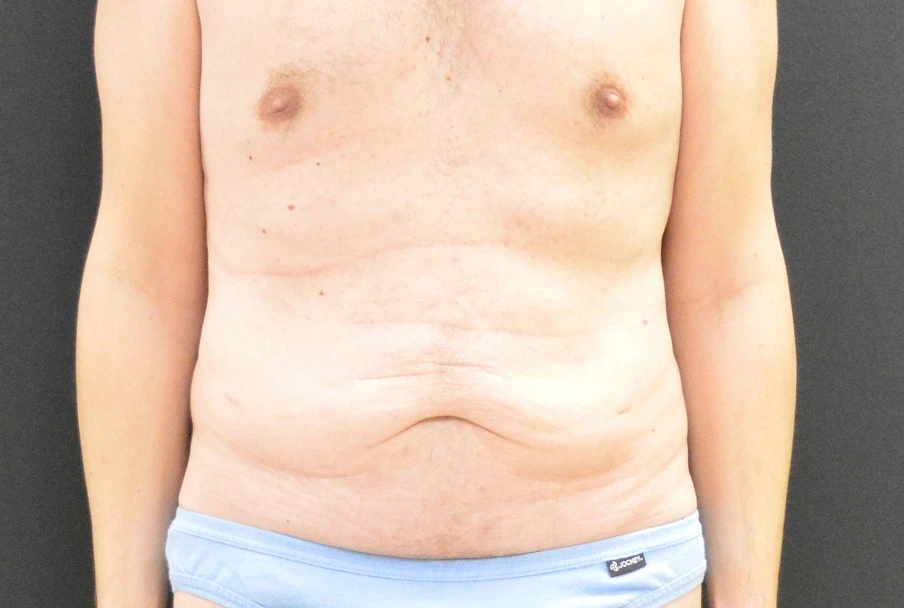 C.L.A.S.S. Tummy Tuck™ Patient Photo - Case 290 - before view-