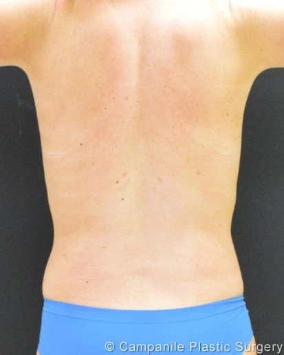 Liposuction - Case 271 - After