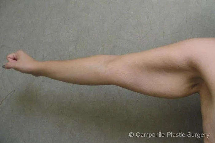 After Massive Weight Loss - Case 87 - Before