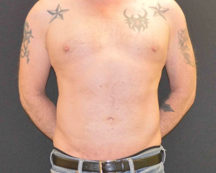 Liposuction - Case 316 - After