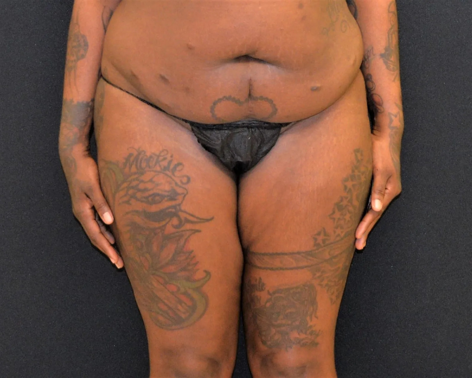 Liposuction Patient Photo - Case 10095 - before view-1
