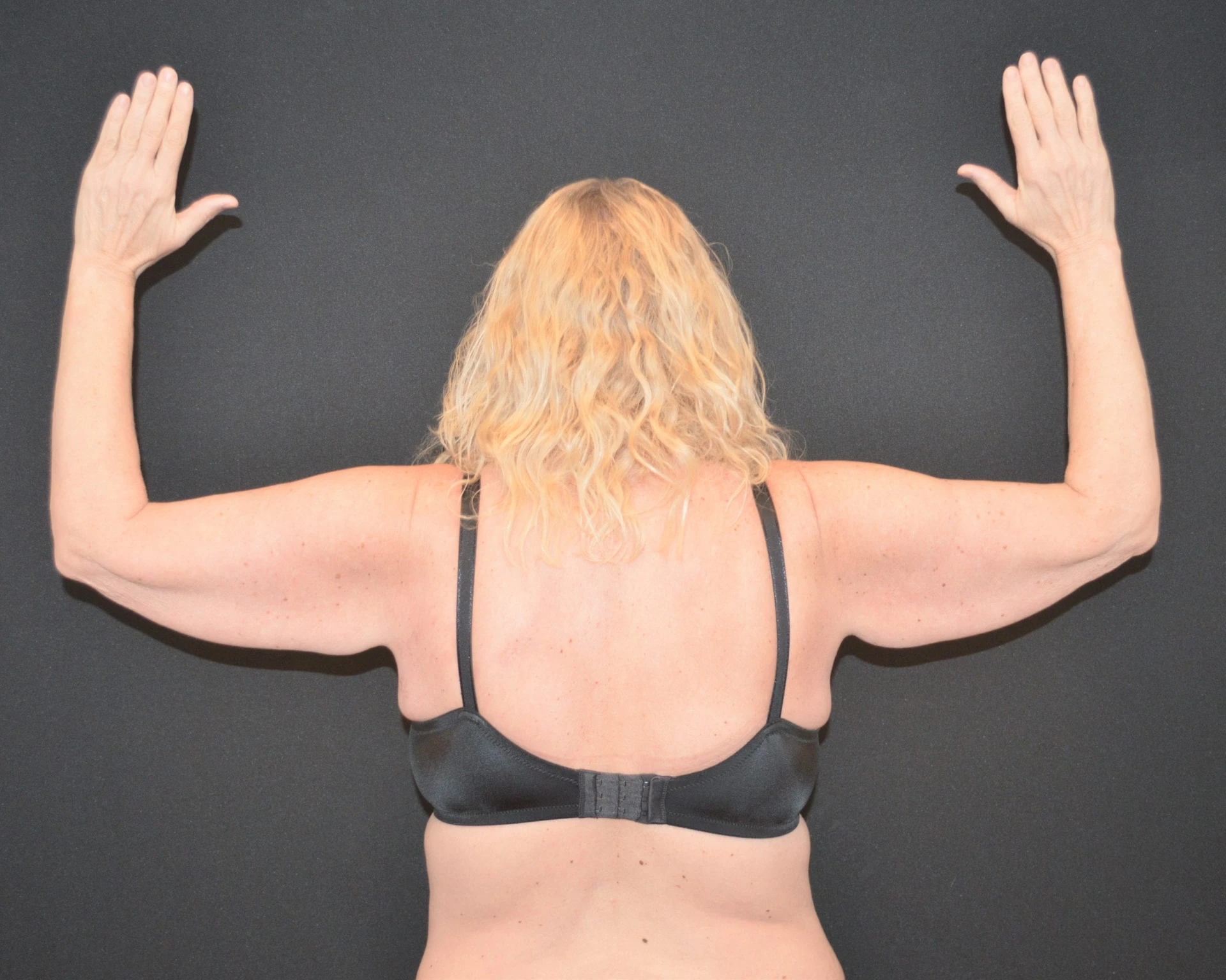 Arm Lift - Case 10533 - Before