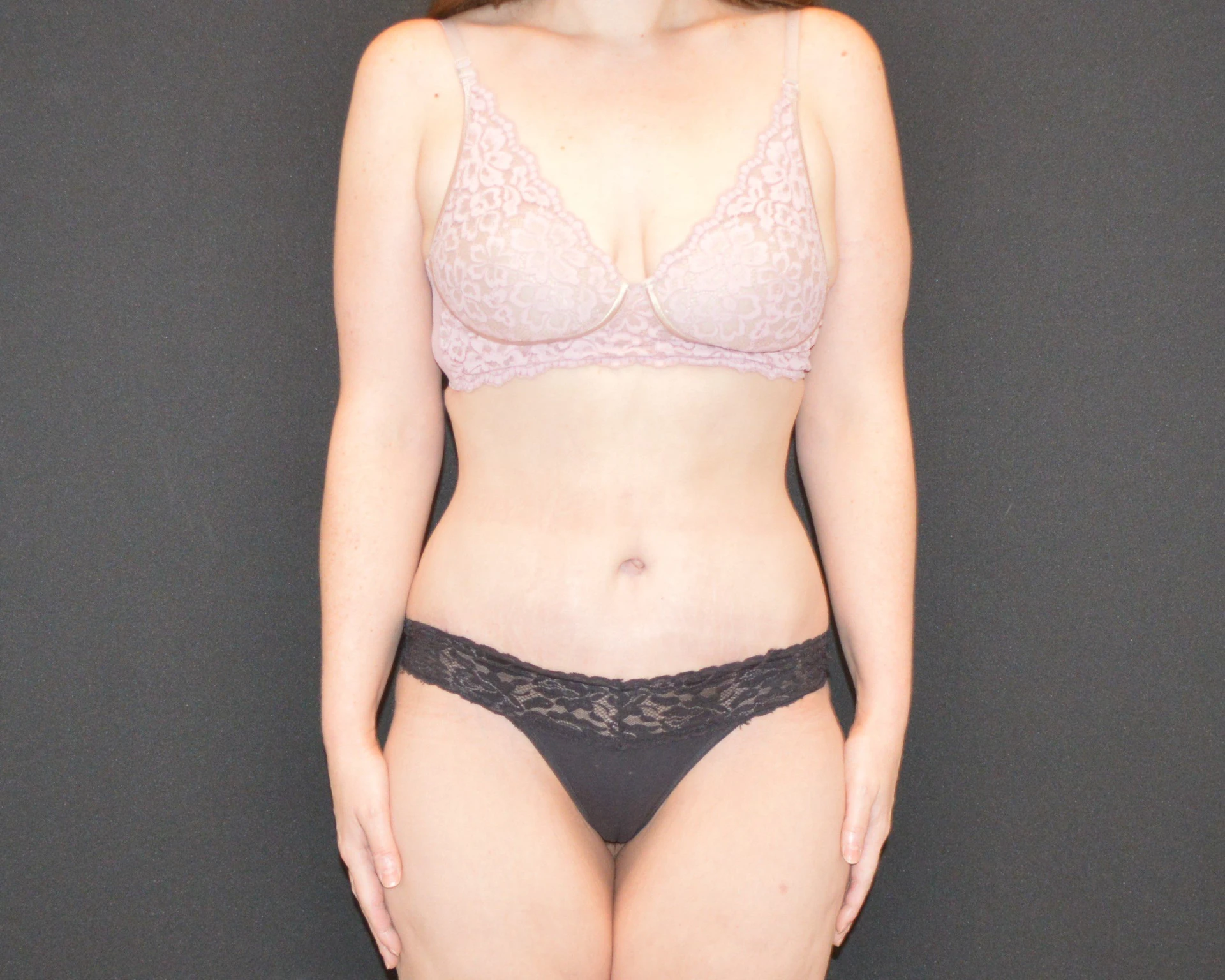 After Massive Weight Loss - Case 11216 - After