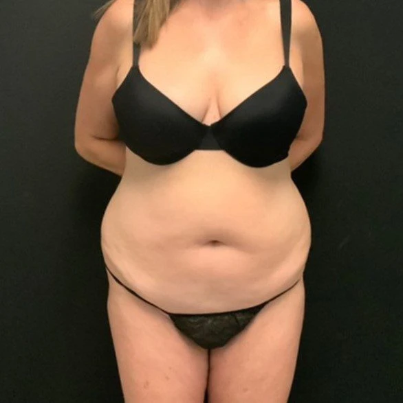 C.L.A.S.S. Tummy Tuck™ - Case 11654 - Before