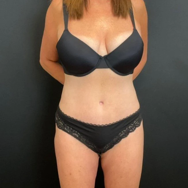 C.L.A.S.S. Tummy Tuck™ - Case 11654 - After