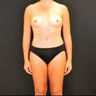 Fat Transfer to the Breasts - Case 11682 - After