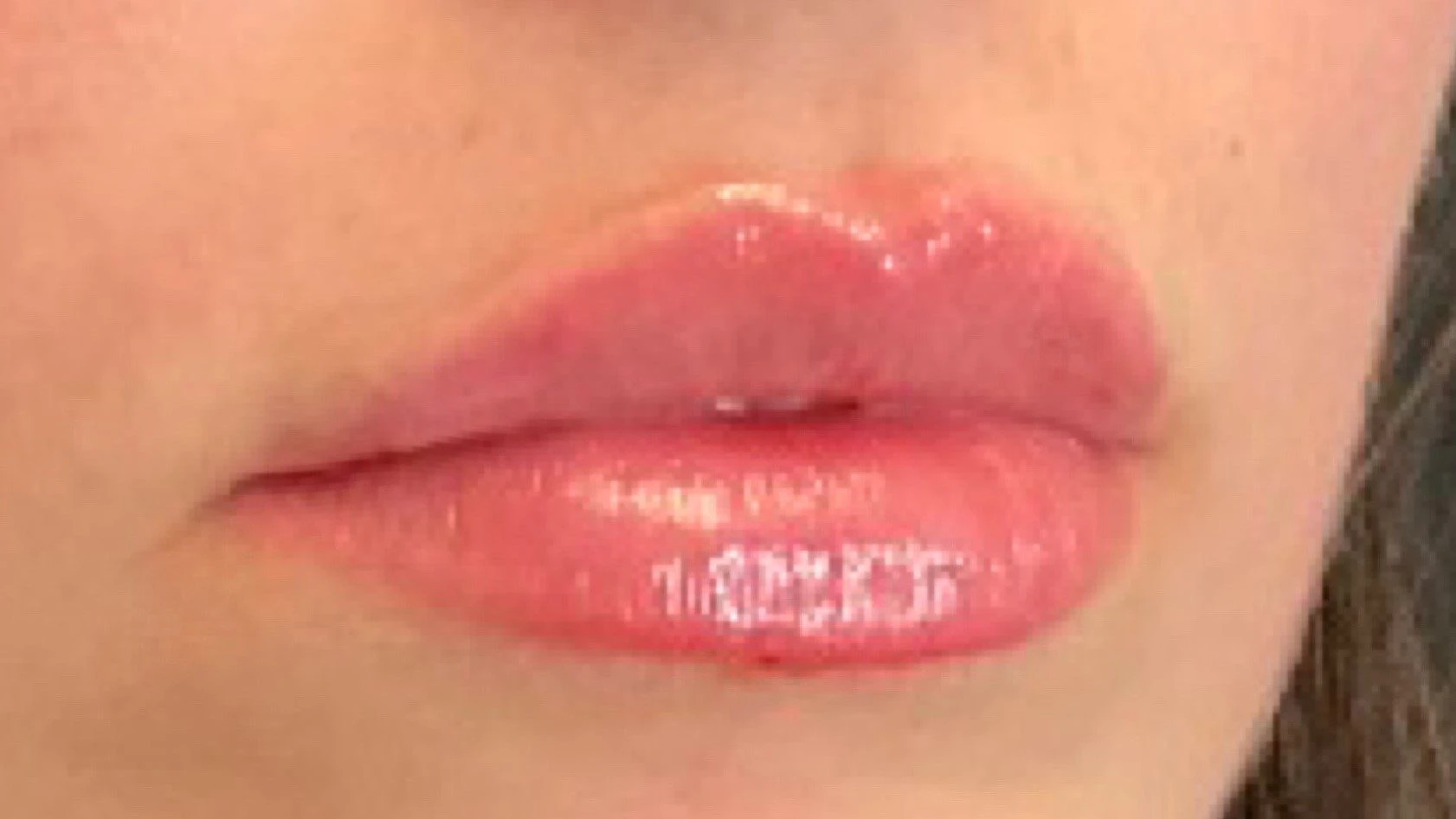 Medical Spa Procedures Patient Photo - Case 11840 - after view