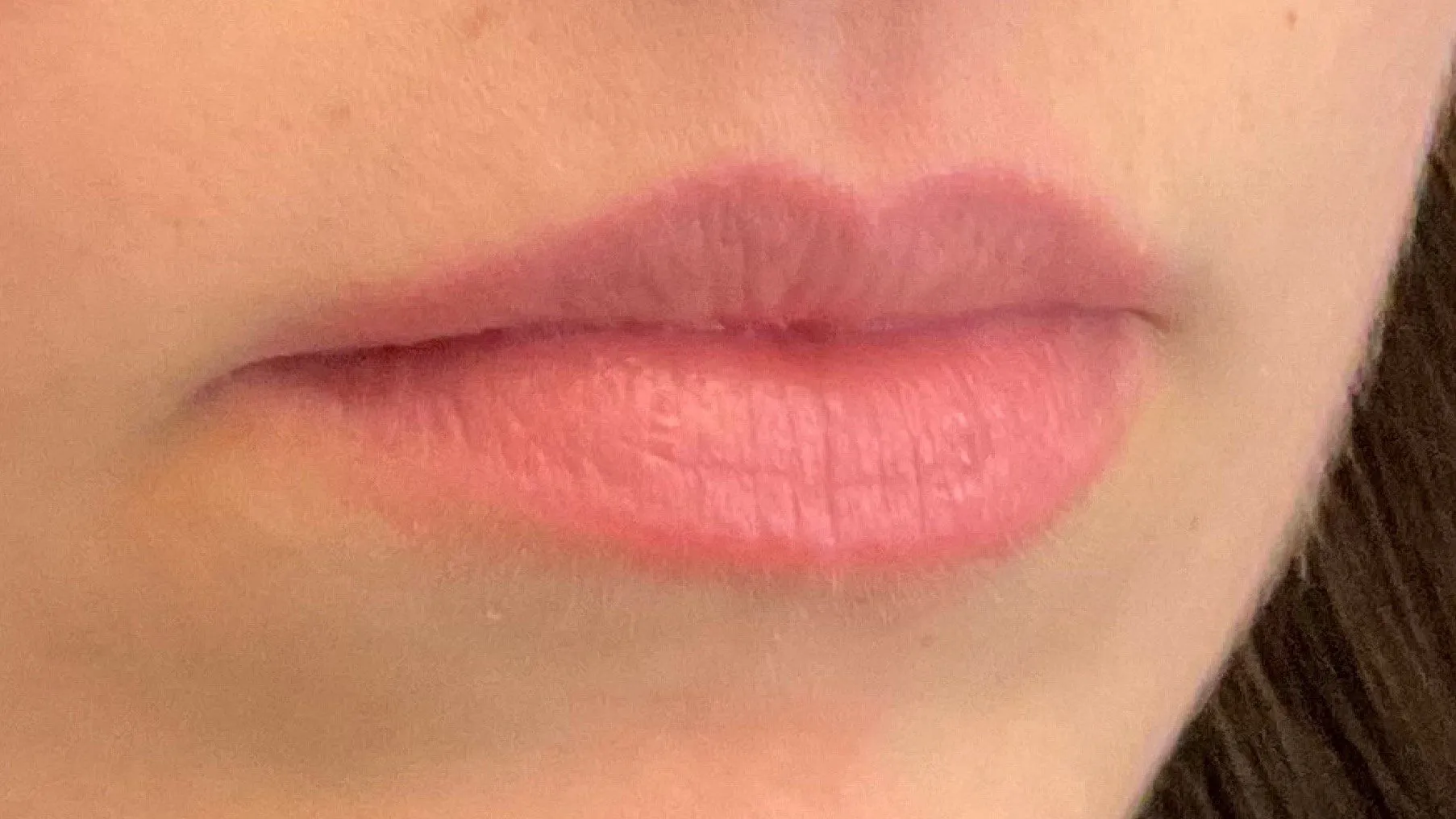 Medical Spa Procedures Patient Photo - Case 11840 - before view-