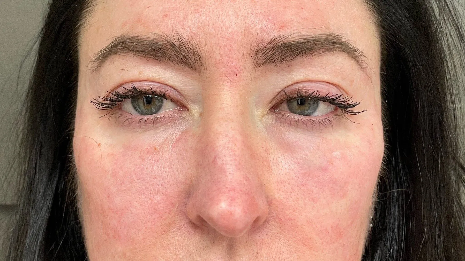 Medical Spa Procedures Patient Photo - Case 11844 - after view