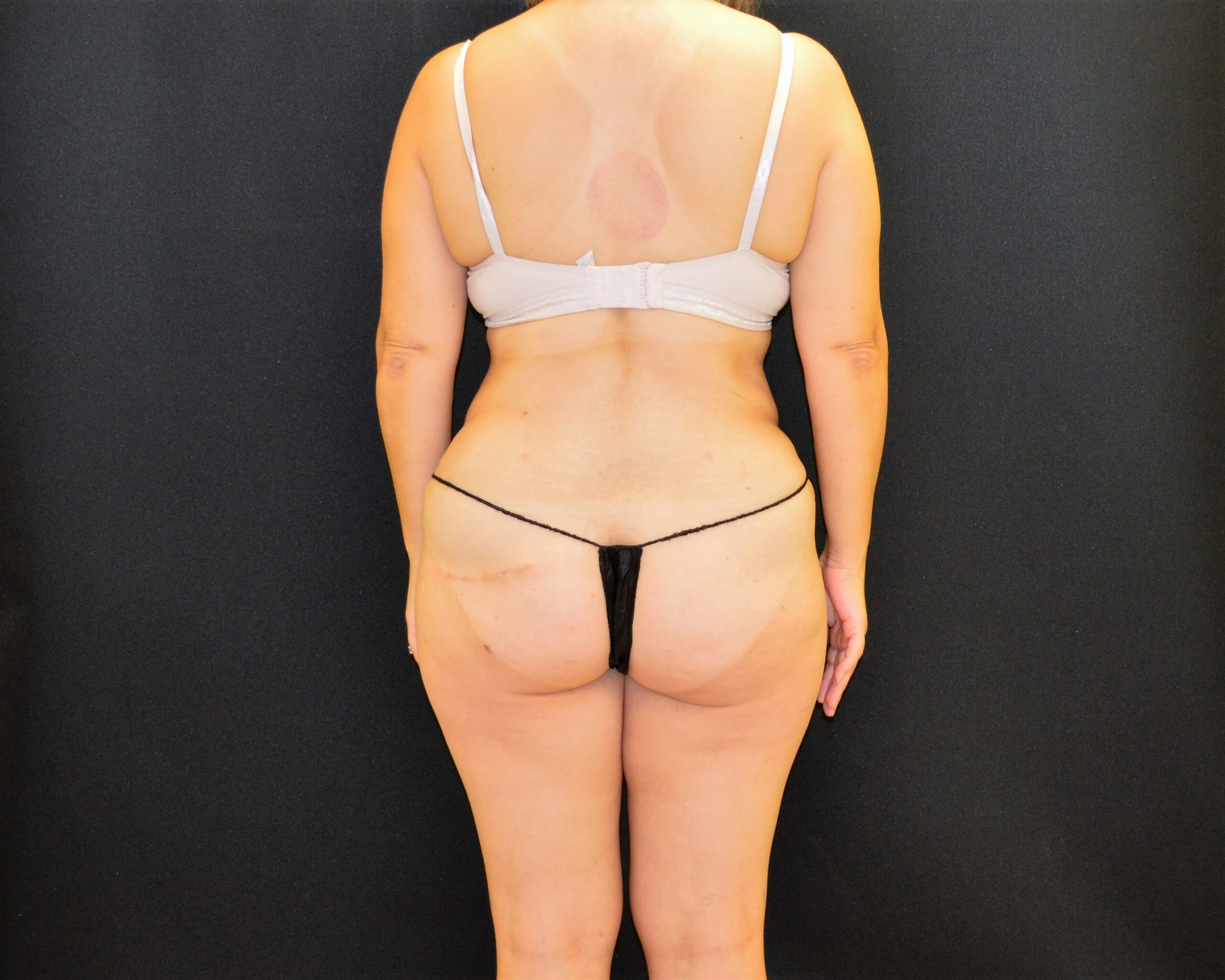 Liposuction Patient Photo - Case 12130 - after view-1