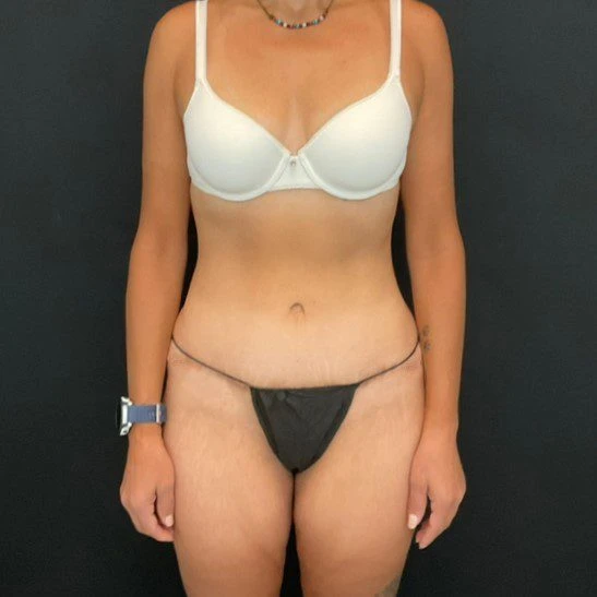 C.L.A.S.S. Tummy Tuck™ - Case 12339 - After