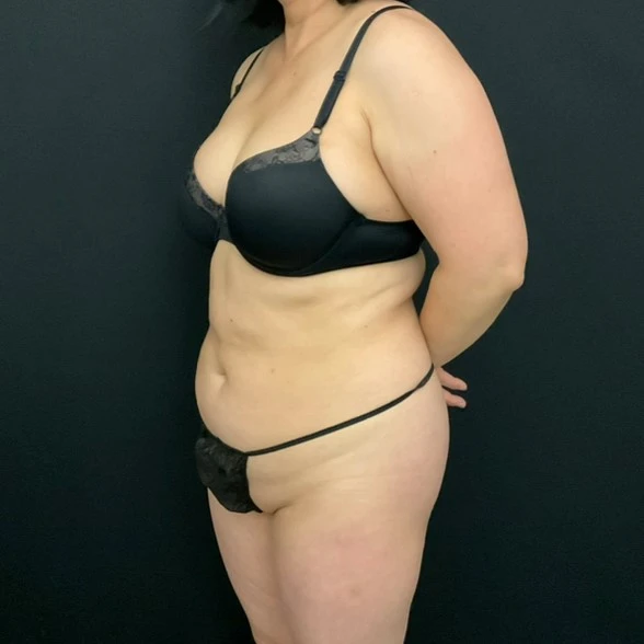 C.L.A.S.S. Tummy Tuck™ - Case 13037 - Before