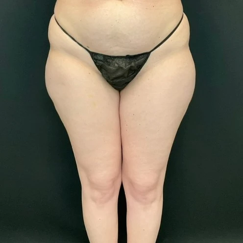 Liposuction - Case 13316 - Before