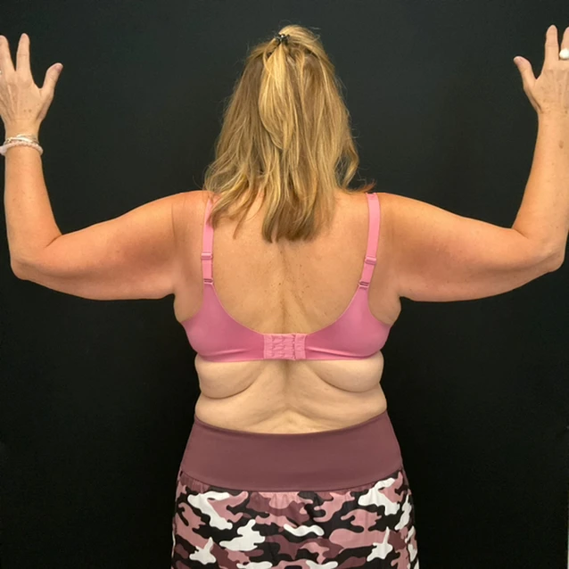 Arm Lift - Case 14168 - Before