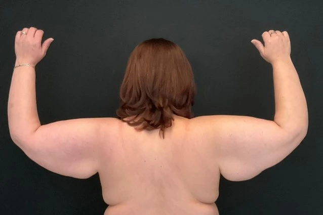 After Massive Weight Loss - Case 14210 - Before