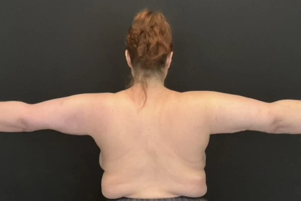 Arm Lift - Case 14214 - After