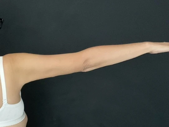 Arm Lift Patient Photo - Case 14436 - after view-1