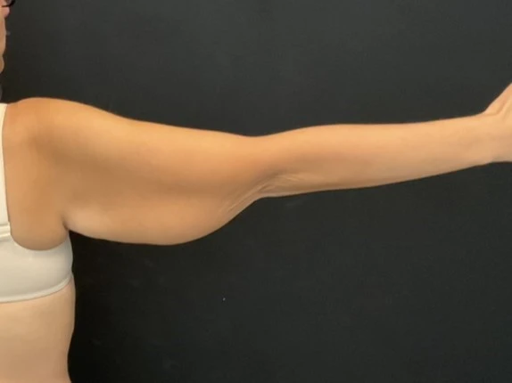 Arm Lift Patient Photo - Case 14436 - before view-1