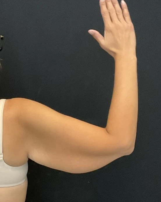 Arm Lift - Case 14436 - Before