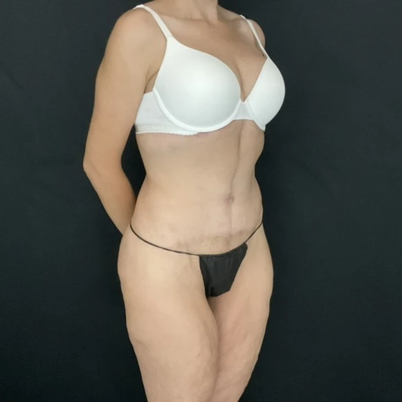 After Massive Weight Loss Patient Photo - Case 14445 - after view-1