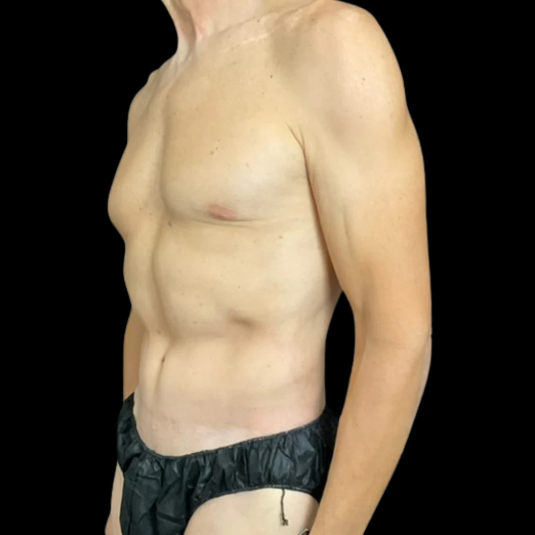 C.L.A.S.S. Tummy Tuck™ - Case 15122 - After